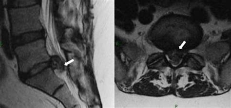 Cauda Equina Syndrome