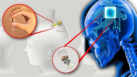 Chip cerebral de Elon Musk: revelado o que pode acontecer com o cérebro