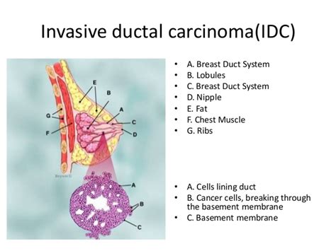 Invasive Ductal Carcinoma and Its Management | New Health Advisor