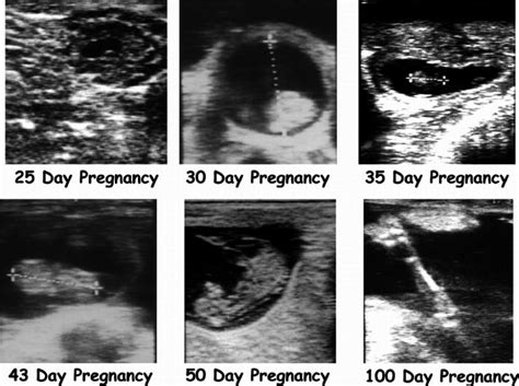 Ultrasound images of embryo or fetal development at various stages of ...