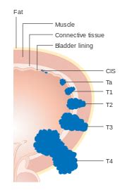 Cancer staging systems - Libre Pathology