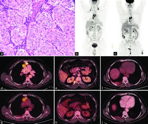 Biopsy from anterior mediastinal mass showed sheets of neoplastic... | Download Scientific Diagram