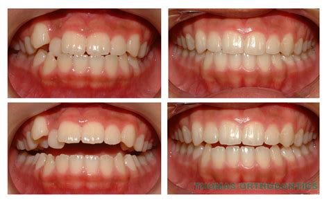 Before And After Gallery - Thomas OrthodonticsThomas Orthodontics