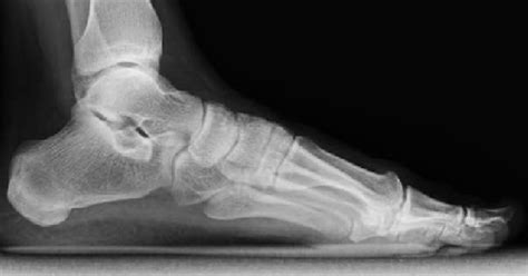 Footlab+ | Eastern Foot Care Sports Podiatrist Dr Andrew McMillan discusses interpretation of X-rays