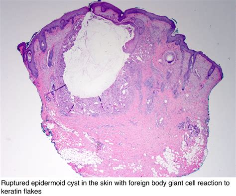 Pedicab Énfasis crisantemo pilar cyst histology índice novato Condición