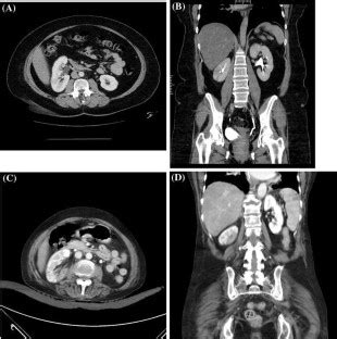 Sagittally malrotated kidney: a case series of two patients | SpringerLink