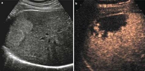 Benign Liver Tumors | Radiology Key