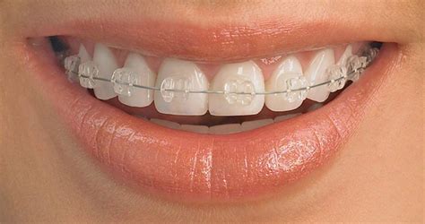 Ceramic Braces – Queensgate Dental Practice