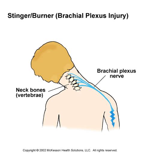 Sports Medicine Advisor 2003.1: Brachial Plexus Injury (Stinger/Burner): Illustration