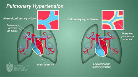 Pulmonary Hypertension - St Vincent's Heart Health