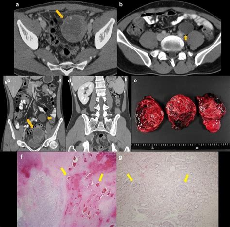 A 29-year-old man with mixed germ cell tumor in the left undescended ...