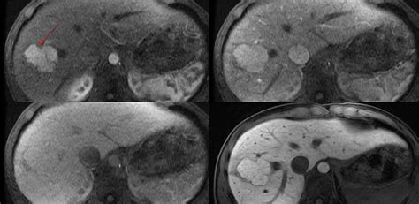 Focal nodular hyperplasia liver causes, symptoms, diagnosis & treatment