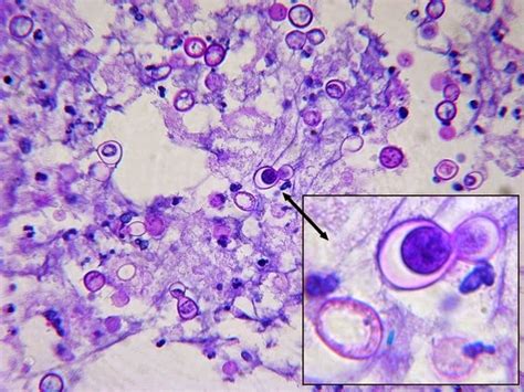 Fun With Microbiology (What's Buggin' You?): Blastomyces dermatitidis