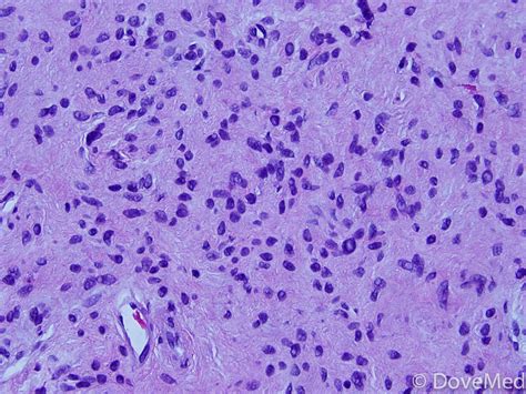 Neurotized Melanocytic Nevus