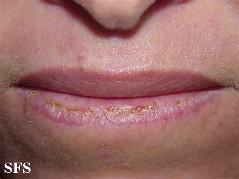 Actinic cheilitis - wikidoc