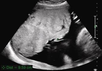 Beckwith-Wiedemann Syndrome | Radiology Key