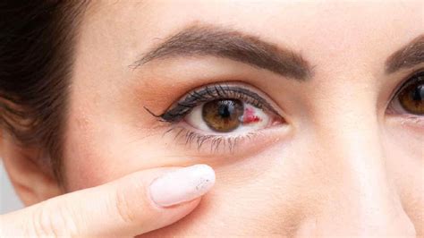 Can You Pop A Blood Vessel In Your Eye From Coughing - Infoupdate.org