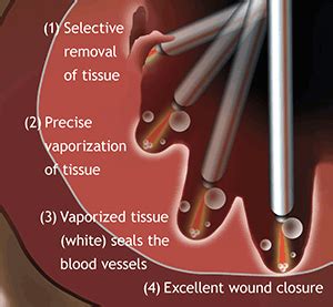 Laser Prostate Surgery for Benign Prostatic Hyperplasia (BPH)