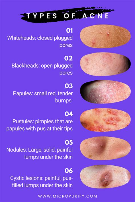 What type of acne do you have? | Types of acne, Natural acne remedies ...