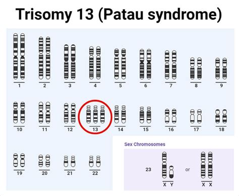 Trisomy- Definition, Causes, Types, Diagnosis, Treatments