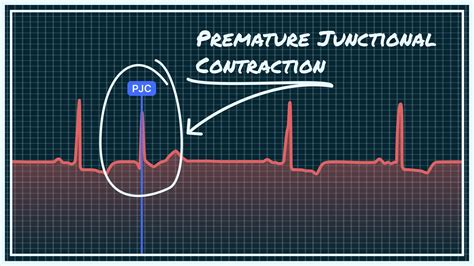 What Premature Junctional Contraction (PJC) Looks Like on Your Watch ...