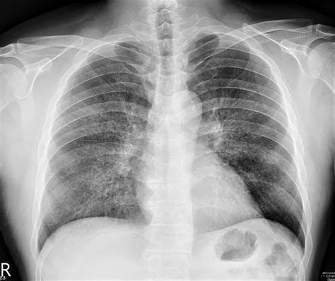 Chest X Ray Infiltrates