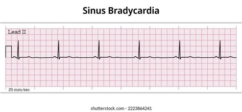 Normal Sinus Rhythm