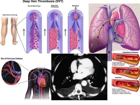 Typical disorders of peripheral blood flow