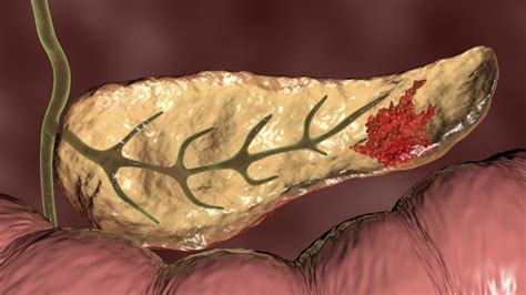 Most Deadly Form of Pancreatic Cancer Reveals Potential Therapeutic Targets