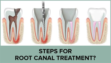 Different Stages of Root Canal Treatment: Step-by-Step Guide