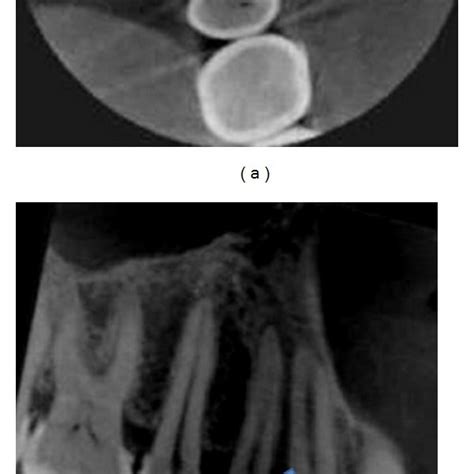 (a) Faint fracture line can be detected on distal marginal ridge... | Download Scientific Diagram