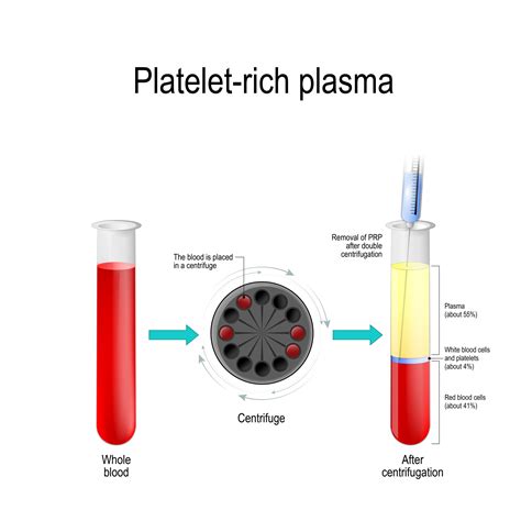 Platelet Rich Plasma Injections | Landry Osteopathic Healthcare, PA LLC.