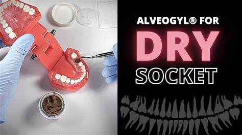 Using Alveogyl To Relieve Dry Socket Pain (Alveolar, 54% OFF