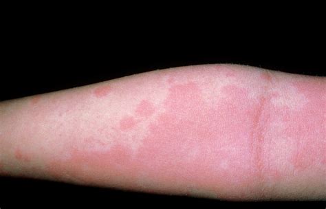 Urticaria; Rash On Arm Photograph by Dr P. Marazzi/science Photo Library