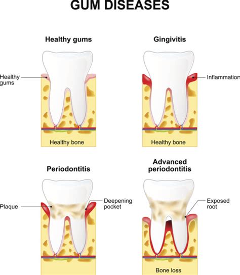 The Cure for Periodontitis: Part 3 - Preserve Your TeethPreserve Your Teeth