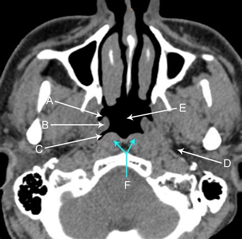 Fossa Of Rosenmuller, Nasopharynx/Nasal cavity at Oregon Health Sciences ... - The human ...