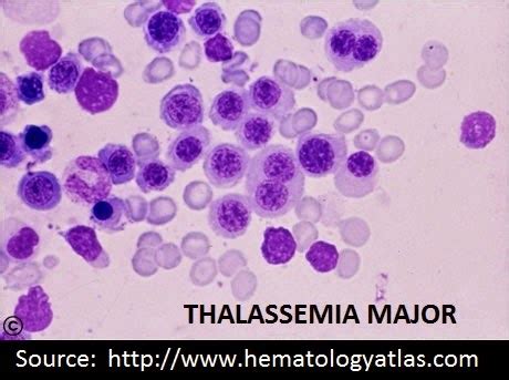 Lab Atlas: Thalassemia Major