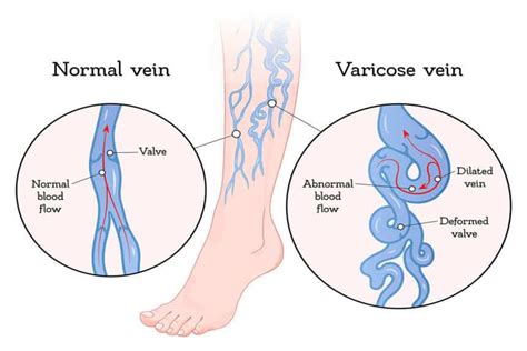 What Causes Varicose Veins? | CORE Medical & Wellness