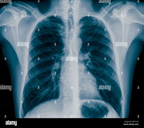 Normal Healthy Chest x-ray of a 36 year old male. front view Stock ...