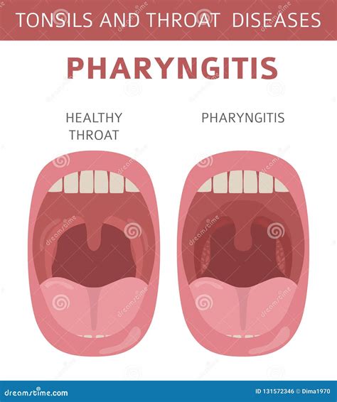 Amígdalas Y Enfermedades De La Garganta Síntomas De La Faringitis ...