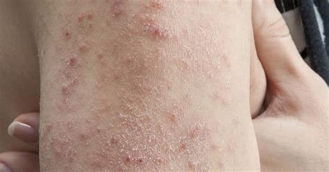 Viruses That Cause Skin Rashes | LIVESTRONG.COM