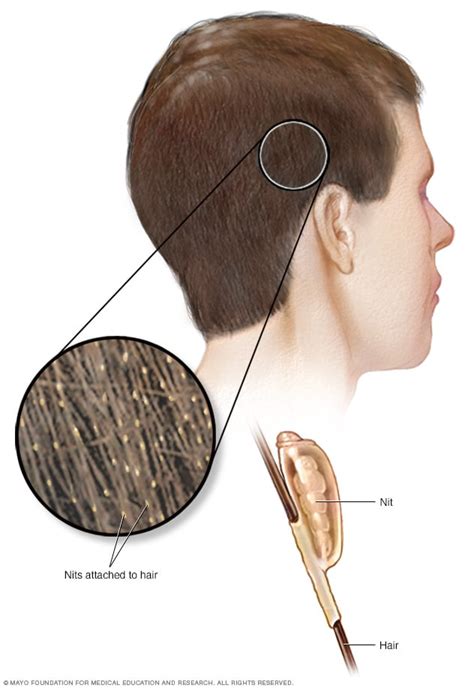 Lice - Symptoms and causes - Mayo Clinic