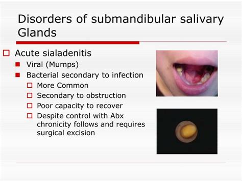 PPT - Salivary Glands Disorders PowerPoint Presentation - ID:734033