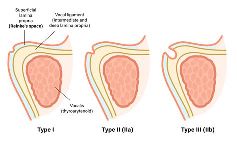 Ford Classification for Sulcus Vocalis