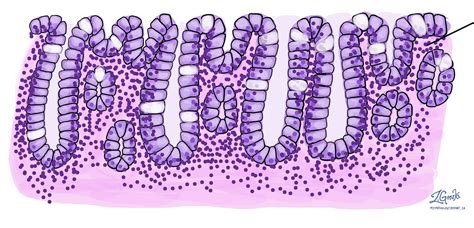 Microscopic colitis | MyPathologyReport.ca