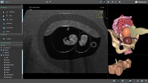 U/S Mentor – OB First Trimester | Simbionix