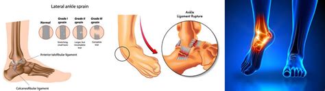 Ankle Instability - Ankle Sprains - Ankle Pain | Preferred Foot & Ankle