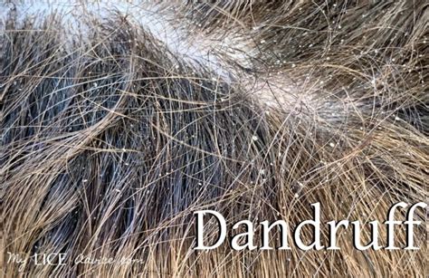 Lice vs Dandruff - 7 Key Differences Between Lice Eggs and Dandruff