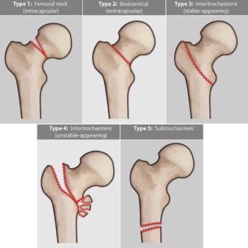 Femoral neck fracture causes, types, symptoms, diagnosis, treatment ...