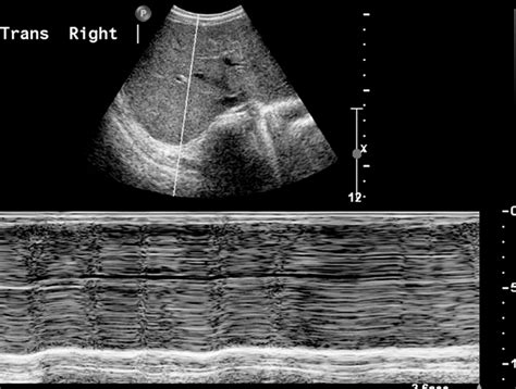 Imaging of the Diaphragm: Anatomy and Function | RadioGraphics